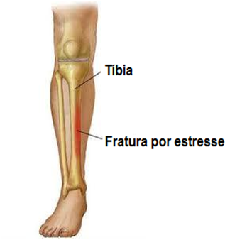 Saiba tudo sobre a fratura de Stress